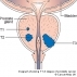 Рак мужских половых органов