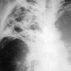 Заболевание лёгких у людей, живущих в неблагоприятных условиях