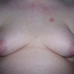 Увеличение груди у мужчин