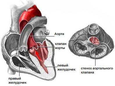 Аортальный стеноз