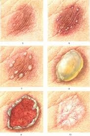 Болезнь кожи и подкожной клетчатки, связанная с излучением