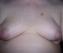 гинекомастия фото, увеличение грудных желез у мужчин описание болезни, gynecomastia признаки и причины заболевания