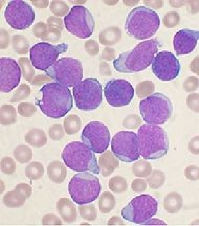 Лейкемия (рак крови)
