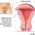 Эндометрит(Воспаление слизистой матки)