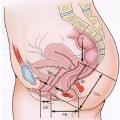 Опущение и выпадение внутренних половых органов