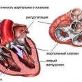 Недостаточность аортального клапана
