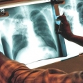 Туберкулез органов дыхания