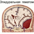 Эпидуральная гематома (кровоизлияние вне мозга)