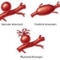 Аневризма бедренной артерии