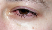 Аллергический конъюнктивит (отек глаз зуд) фото