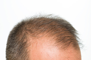 Алопеция (выпадение волос) фото