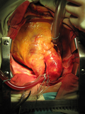 Анатомический аневризма аорты (расширение) фото