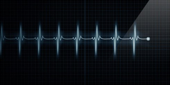 Аритмия (аномальный сердечный ритм) фото