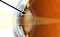 катаракта фото, слепота описание болезни, катаракта признаки и причины заболевания