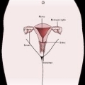 Аномалии положения женских половых органов