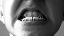 Бруксизм (скрежетание зубами) фото