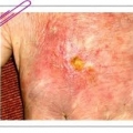 Болезнь кожи и подкожной клетчатки, связанная с излучением