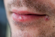 Герпес стоматит (вирусные инфекции полости рта) фото