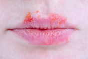 Герпес стоматит (вирусные инфекции полости рта) фото