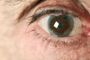 Глаукома (повышенное глазное давление) фото