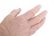 Контактный дерматит (раздражение Связаться с кожей) фото