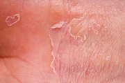 Контактный дерматит (раздражение Связаться с кожей) фото