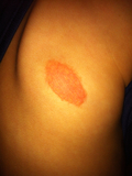 Pityriasis розовой (воспалительные кожные высыпания) фото
