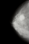 Рак молочной железы (опухоли) фото