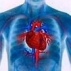 Атеросклеротическая болезнь сердца