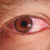 Аллергический конъюнктивит (отек глаз зуд) фото