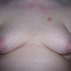 гинекомастия фото, увеличение грудных желез у мужчин описание болезни, gynecomastia признаки и причины заболевания