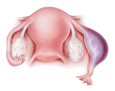 Внематочная беременность (трубная беременность) фото