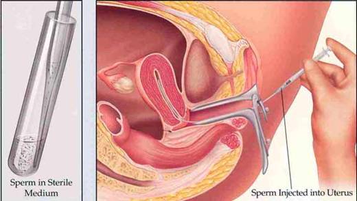 artificial-insemination-for-infertility_clip_image002_0000
