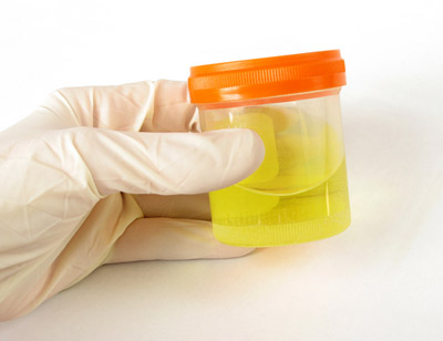 Urine-for-Diabetes-Testing