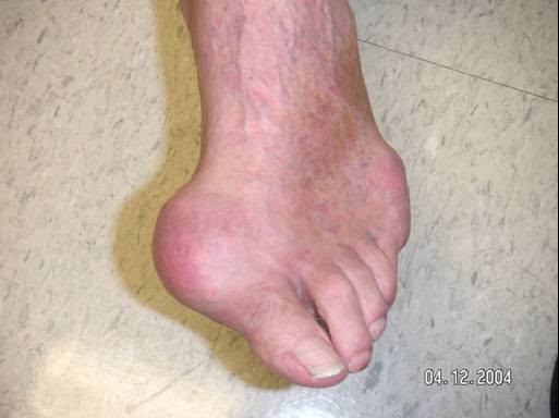 gout_foot-44