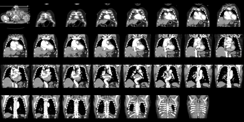 CT ангиограмма шеи фото