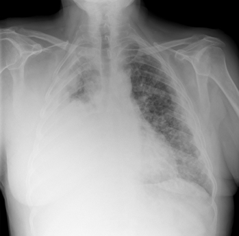 Рентгенограмма пищевода фото