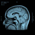 МРТ головного мозга с красителем фото