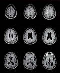 МРТ головного мозга с учетом и без красителя фото
