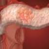 Лапароскопическая резекция головки поджелудочной железы
