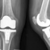 Ортопедические имплантаты с наноалмазным покрытием