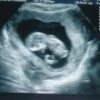 Ребенок прооперирован в утробе матери на сроке 26 недель