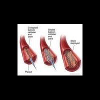 Стволовые клетки помогут в лечении больных с инфарктом миокарда